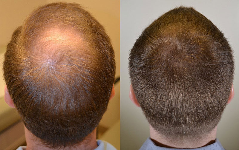 Propecia gegen Haarausfall
